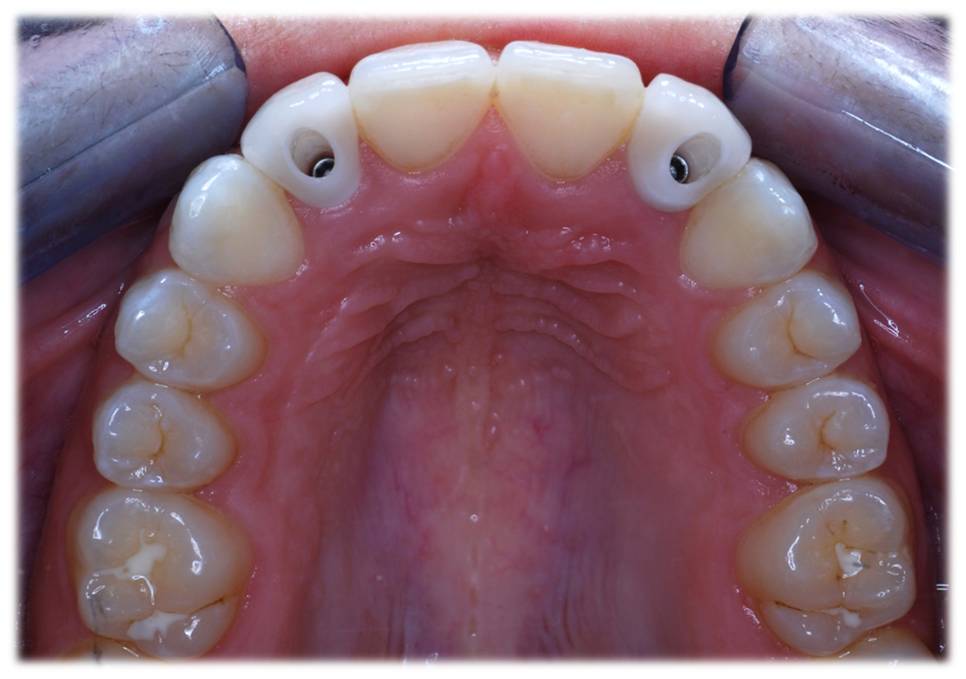 implantes arcada completa superior 